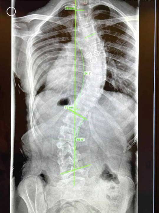 An x-ray image of a spine curved from scoliosis.
