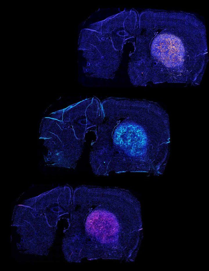 A series of three brain scans showing T-cells attacking a glioblastoma over time. The third scan shows dying glioblastoma cells.