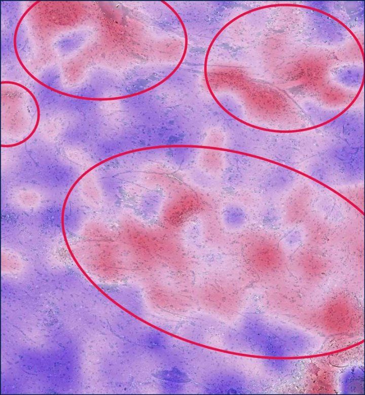 Microscopy image with red and blue heat-map regions circled to highlight areas of cancer cell infiltration.