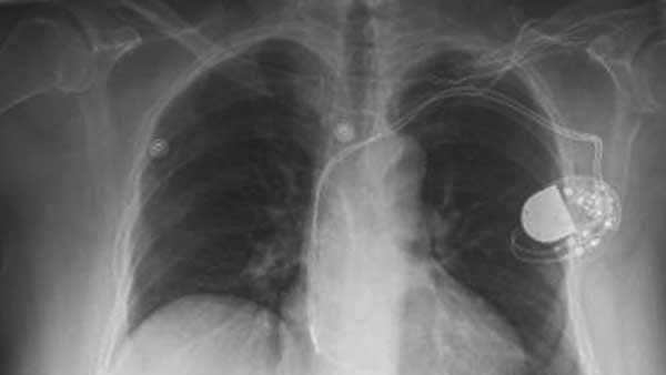 X-ray of patient showing pacemaker.