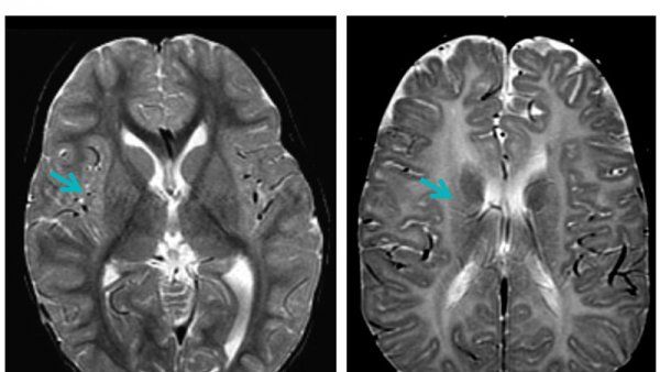 PMD brain scan