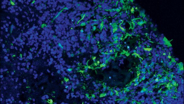 microscope image of green glioblastoma cells and blue brain organoids