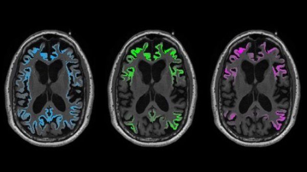 PET scan of brain showing Tau protein