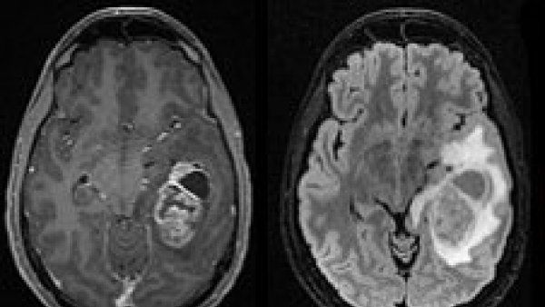 MRIs of brain tumor before and after surgical removal