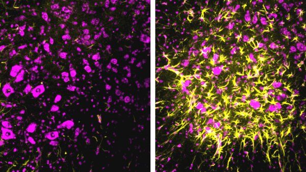 spinal cord neurons in mice with ALS