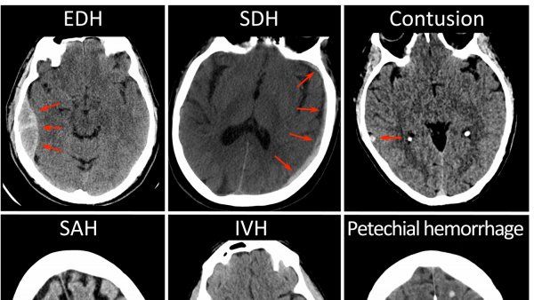 Black-and-white CT images of brains with signs of concussion