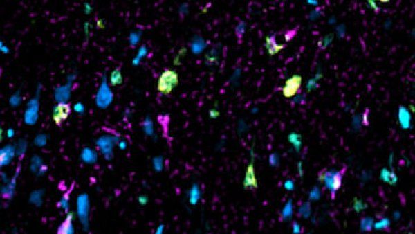 Fragments of tau protein appear as green and cyan spots amid purple spots (neurons) in brain tissue sample
