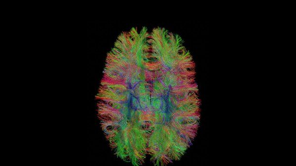 A tractography of an overhead view of a brain. White matter bundles are represented by multi-colored fibers
