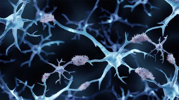 A 3D rendering of amyloid plaques in the brain, signaling Alzheimer's.