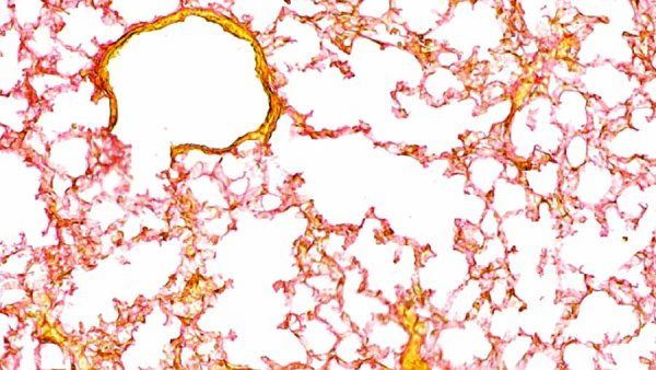 A microscopic image showing that fibrosis have cleared and improved after treatment.