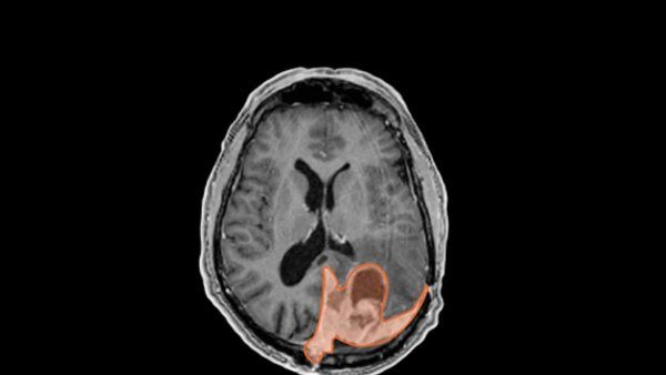 MRI scan of brain with tumor highlighted in pink.