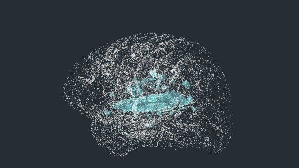 A representation of the brain highlighting the superior temporal gyrus (in blue), which helps us understand spoken language.