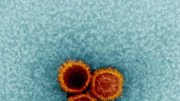 An electron micrograph showing three Epstein-Barr virus (EBV) particles colorized in red and orange.