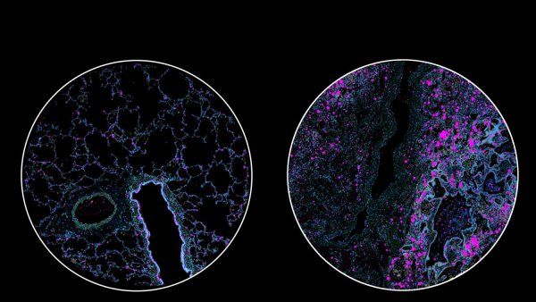 Two microscopic images comparing lung tissue that is healthy to a sample from a patient with severe COVID.