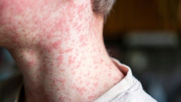 Close-up of a measles rash on a person's neck.