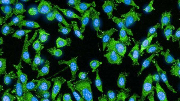 Fluorescence microscope image showing a dense field of lung cancer cells covering most of the image. The cells are green with blue nuclei and are closely packed together before treatment.