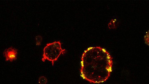 Microscopy image of lab-grown dendritic cells in red with absorbed tumor cell fragments highlighted in yellow.
