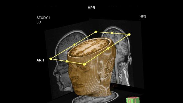 A 3D rendering of a face and brain.