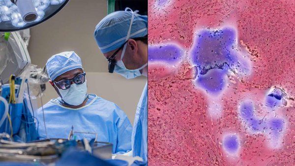 A side-by-side image showing surgeons and a microscopic image of a glioma.