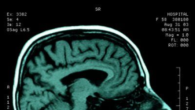 MRI scan.jpg