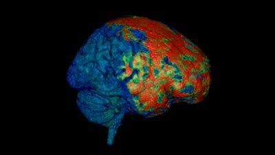 brain_concussion_MRI.jpg