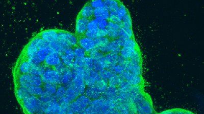 breast-cancer-cells2.jpg