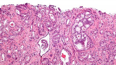 prostate-cancer-cells.jpg