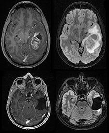 MRIs of brain tumor before and after surgical removal