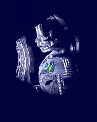 fetal ultrasound with area of the heart highlighted in different colors