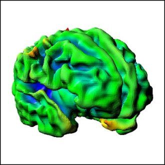 A 3D model of a baby's brain at full term at 40 weeks, but with signs of underdevelopment due to hypoplastic left heart syndrome.
