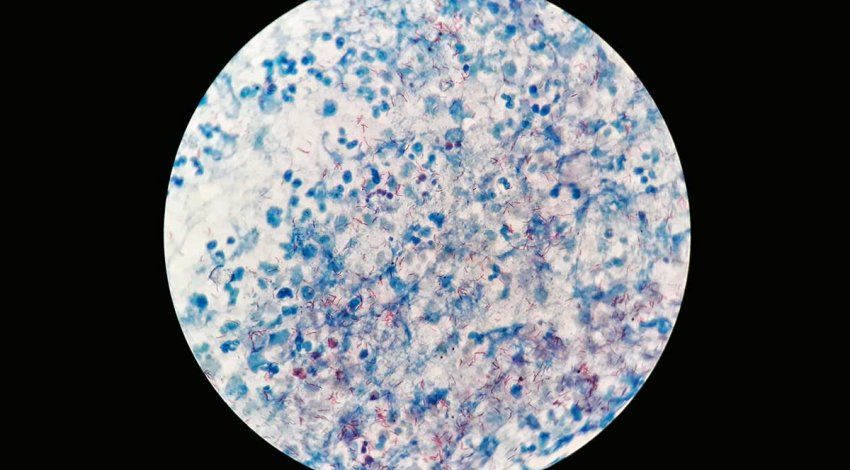 Tuberculosis as seen under the microscope.