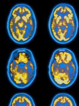stock image of PET scans of a brain