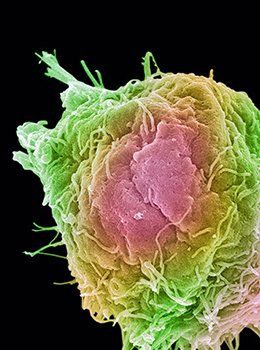 A cancer cell extending tendrils beyond its cell body