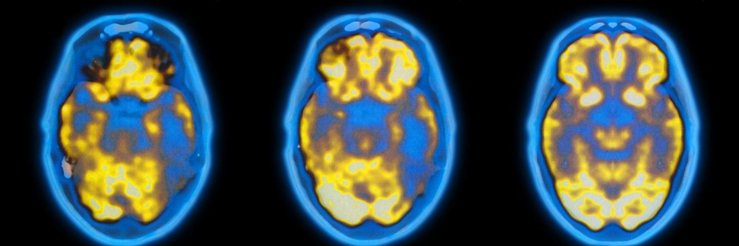 PET scan of a brain