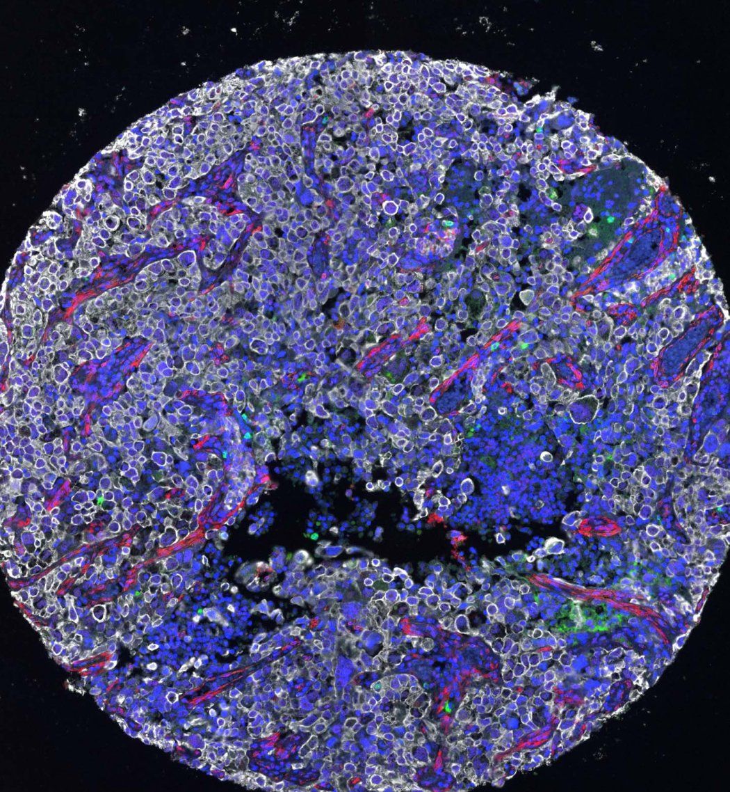 Microscopy showing a biopsy of lung tumor tissue 