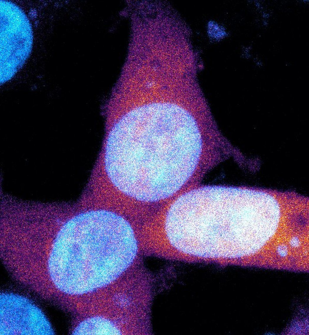 A microscopic image of three cells, with amyloid beta marked in pink