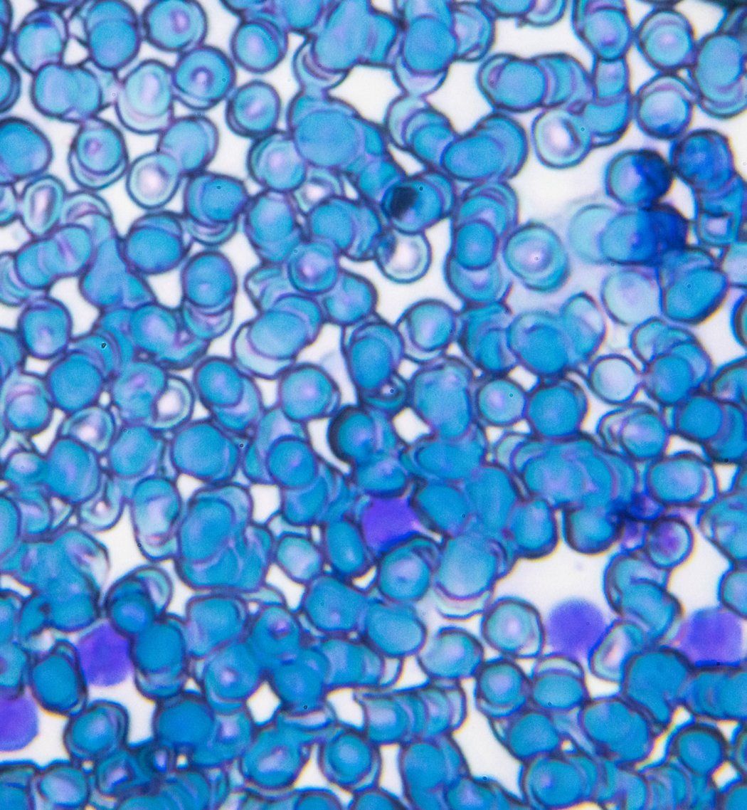 Microscopy of blue and purple cells showing cute lymphoblastic leukemia
