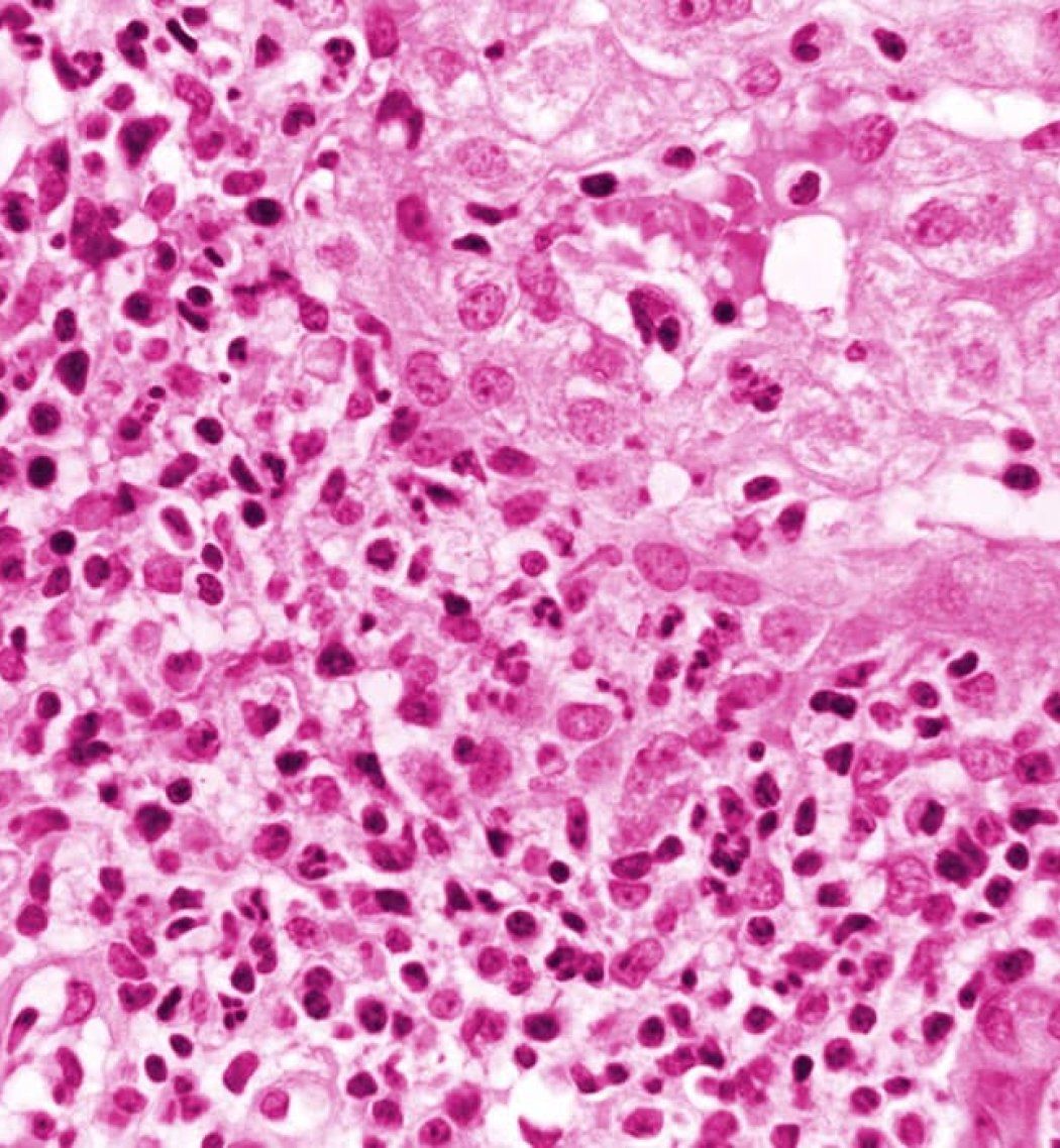 A photomicrograph of a liver tissue specimenwith damange from viral hepatitis.