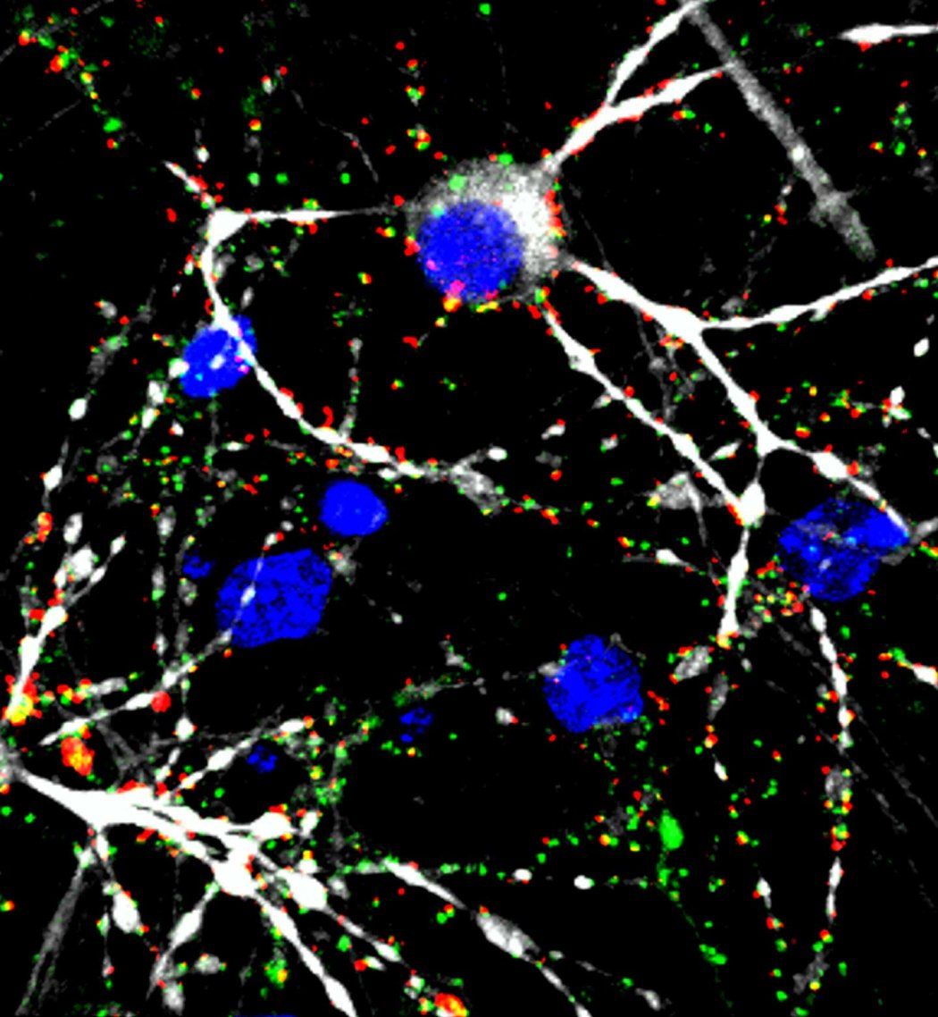 Microscopy of white connections between blue glioblastoma cells.