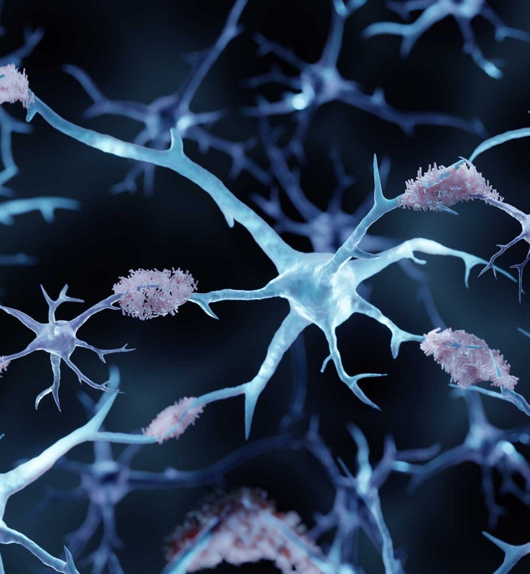 A 3D rendering of amyloid plaques in the brain, signaling Alzheimer's.