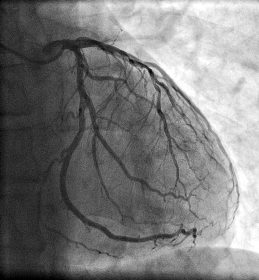 An angiogram showing the left coronary artery with its branches.