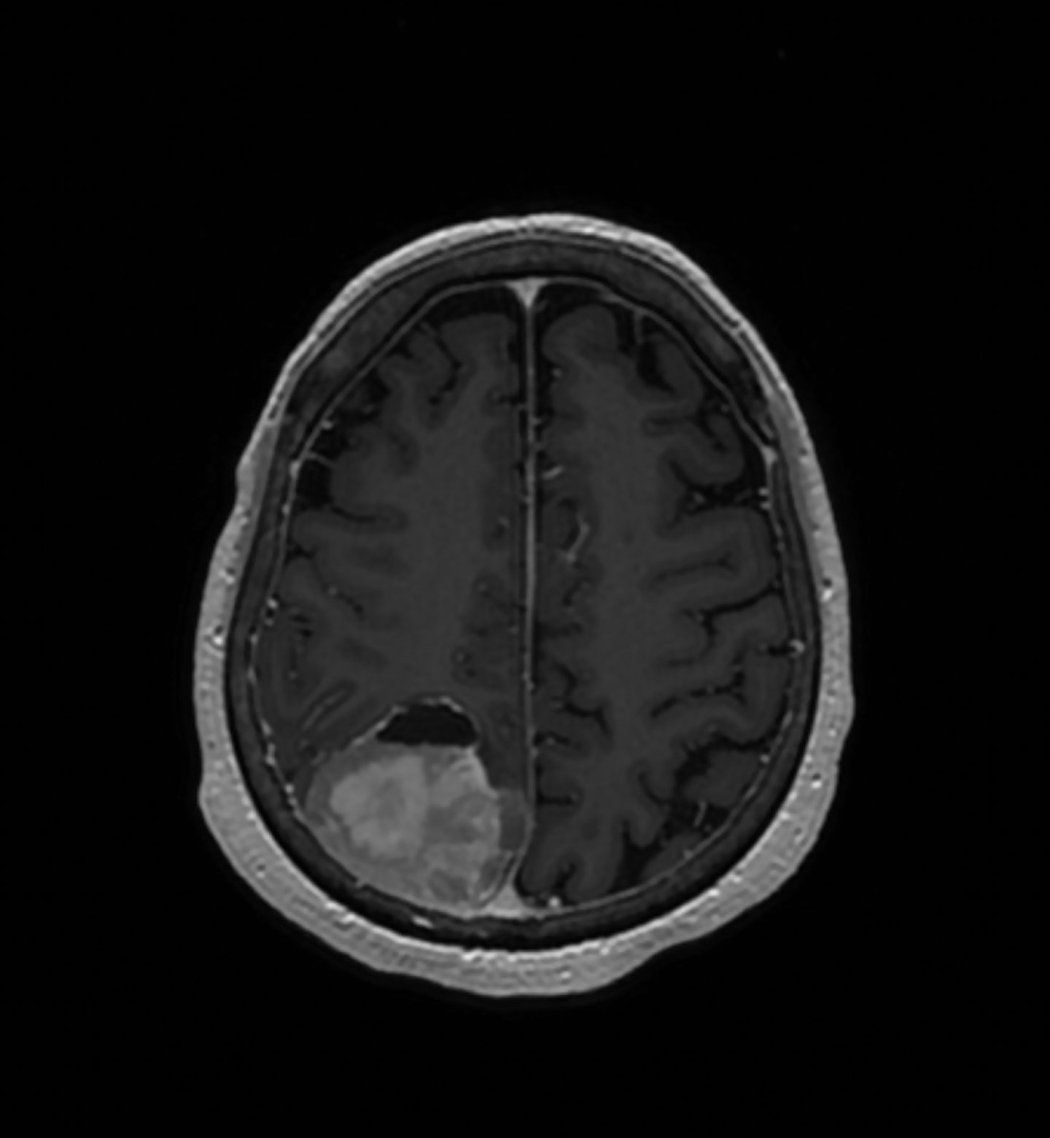 A black and white MRI scan of a brain with a tumor on the lower left side.