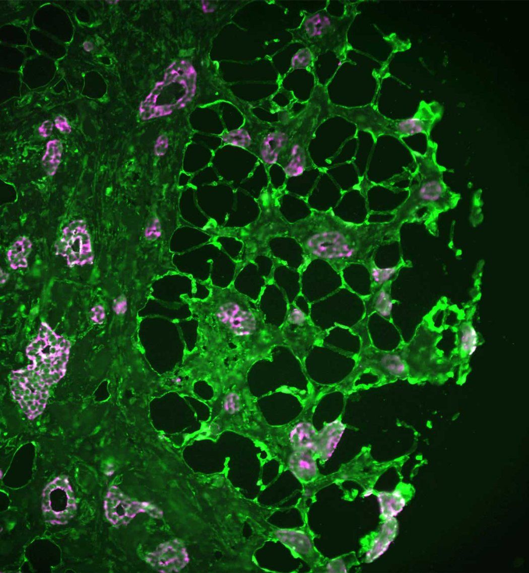 A microscopic image of breast tissue showing molecular tunnels briding tumor cells with nearby fat cells.