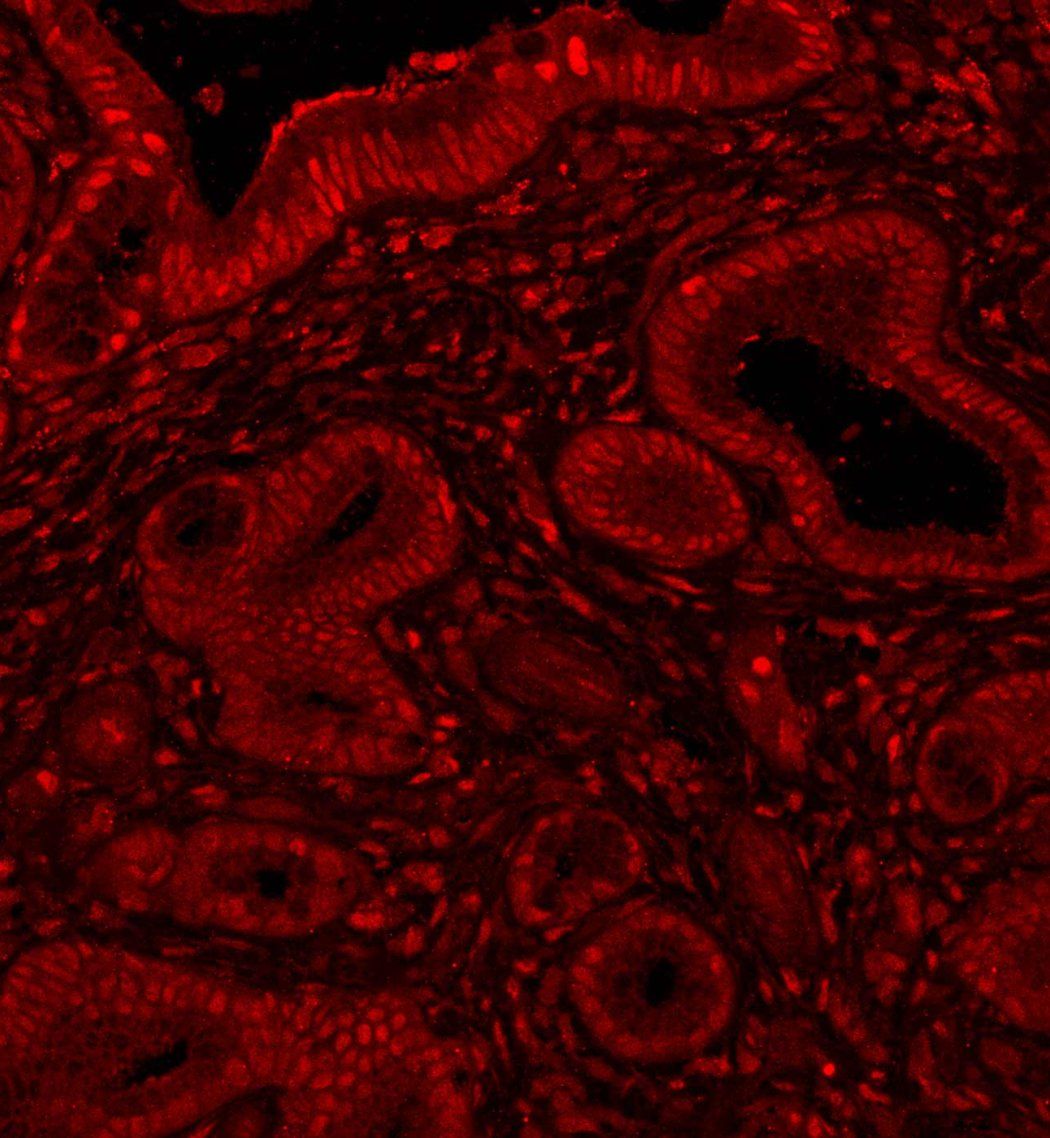 A microscopic image showing the presence of the M Y C protein in a pancreatic biopsy. M Y C is shown in red among a black background.