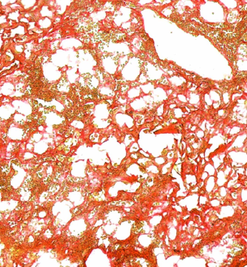 A microscopic image showing the presence of fibroses in a lung.