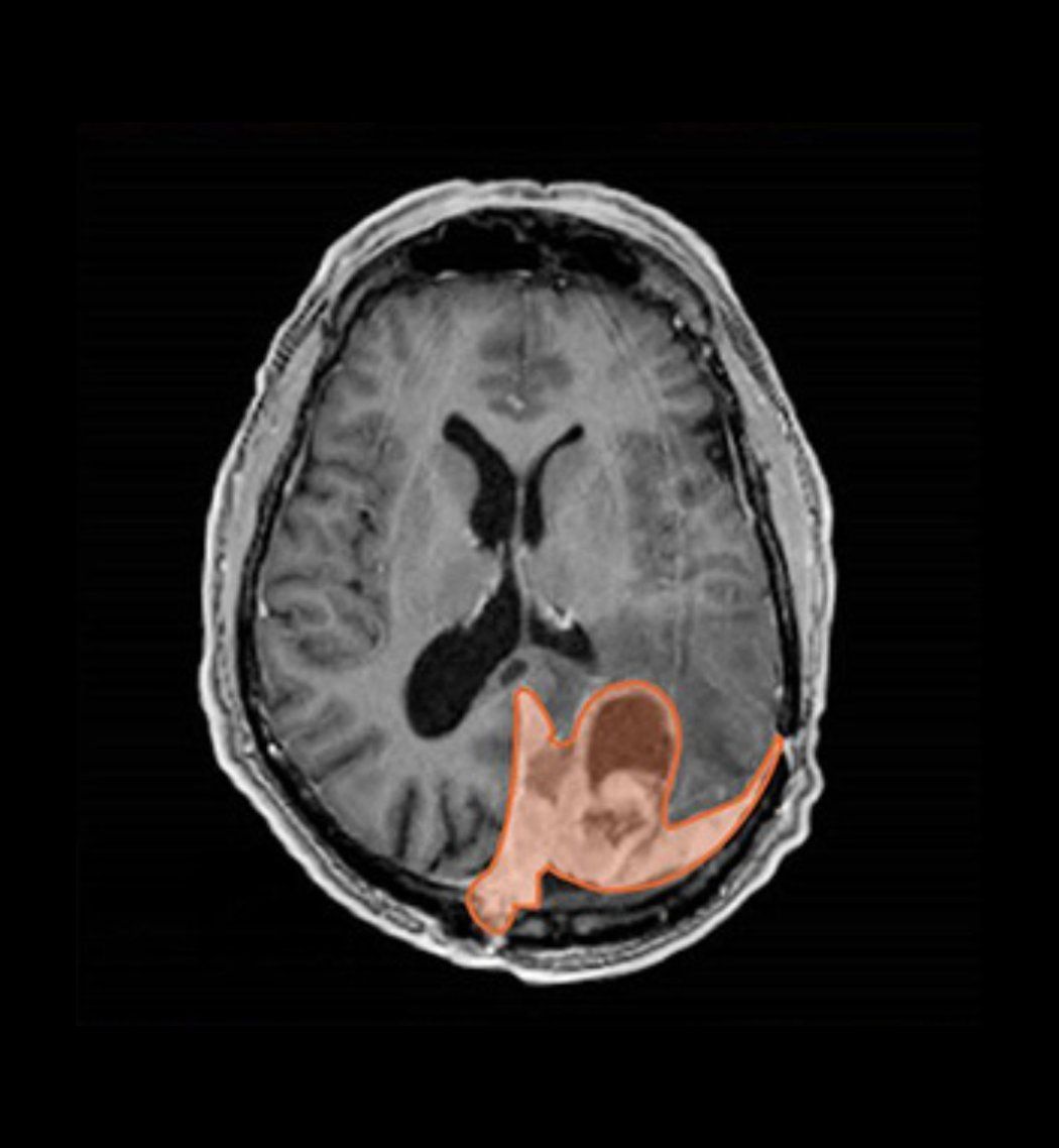 MRI scan of brain with tumor highlighted in pink.