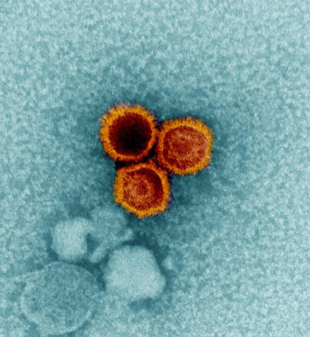 An electron micrograph showing three Epstein-Barr virus (EBV) particles colorized in red and orange.