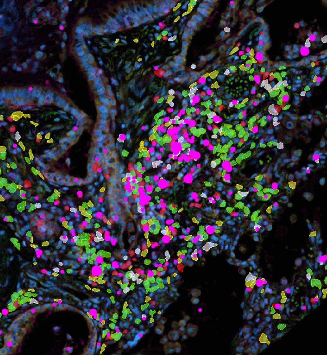 Microscopic image showing colorful clusters of fibroblasts and immune cells in lung samples.