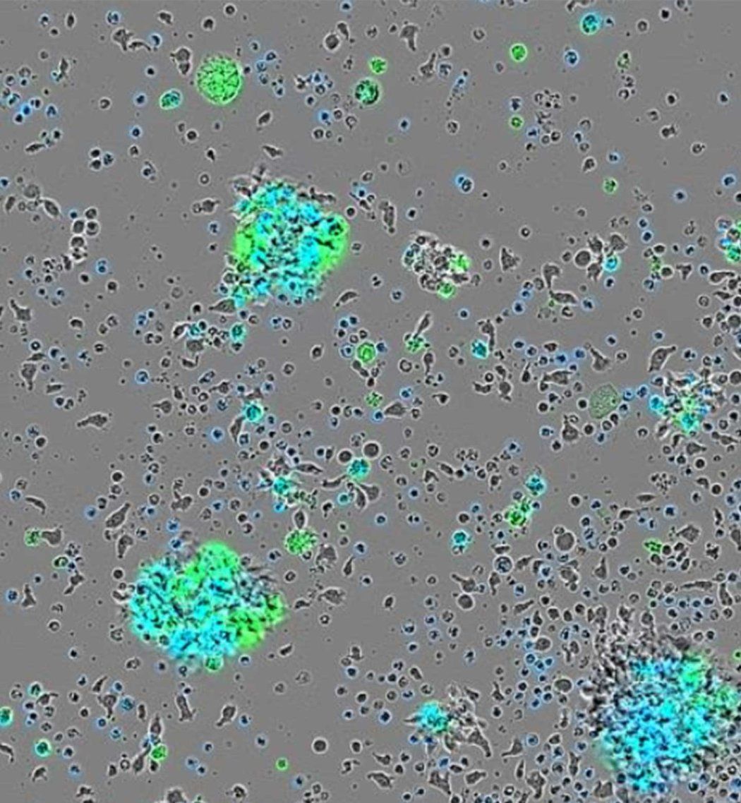 A microscope image of tumor cells where scattered clusters glow with bright green and turquoise highlights, representing the accumulation of radioactive antibodies.