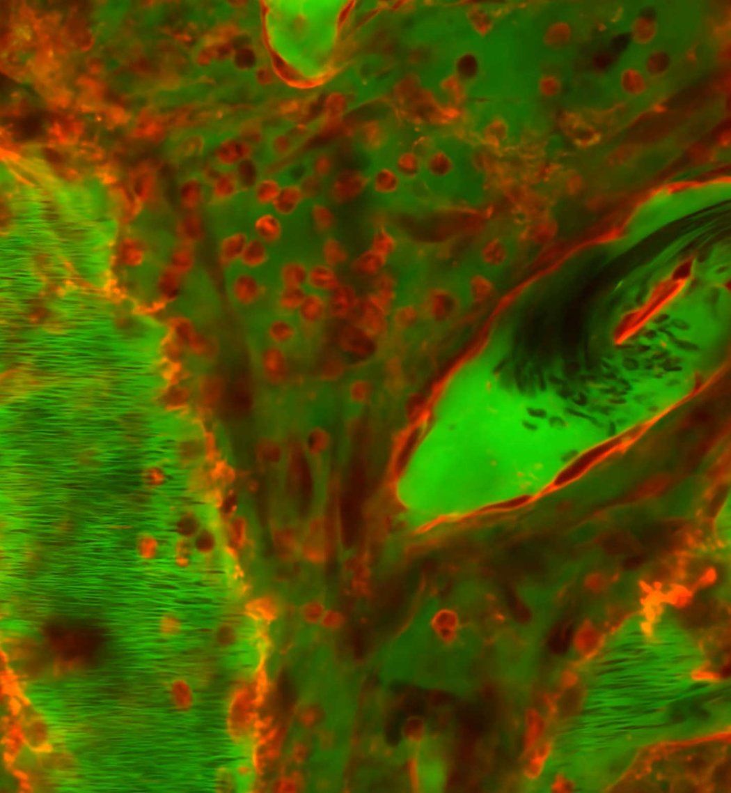 A microscopic image showing blood leaking into brain tissue after a traumatic brain injury.